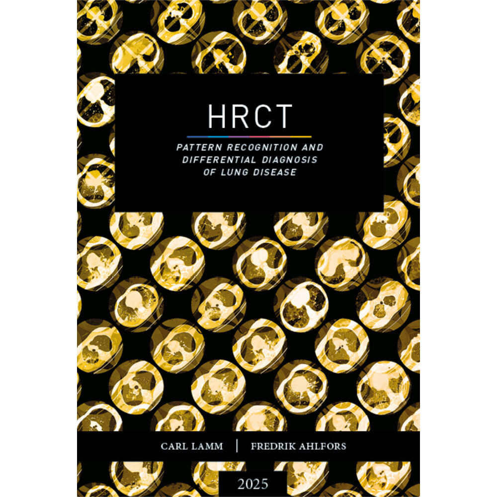 Carl Lamm HRCT : pattern recognition and differential diagnosis of lung disease (bok, danskt band, eng)